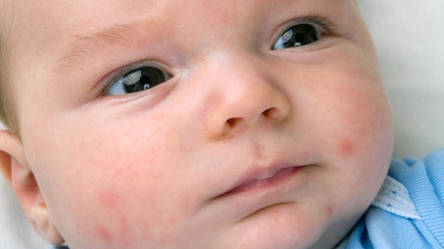 AM_b_hea_A-guide-to-baby-eczema_WP